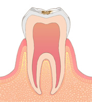 虫歯の進行レベルC1