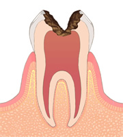 虫歯の進行レベルC3