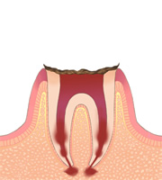 虫歯の進行レベルC4