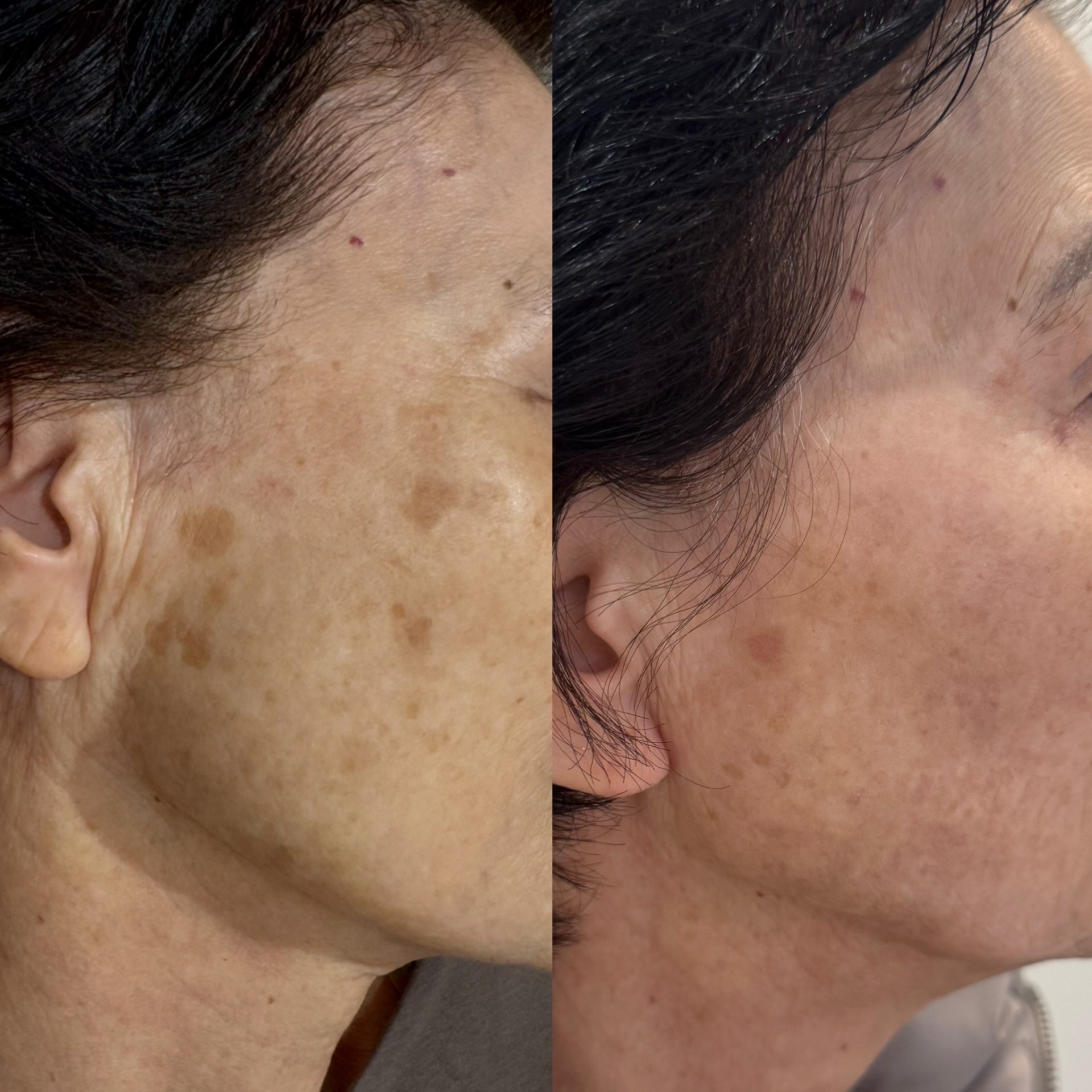 シミ取りレーザー