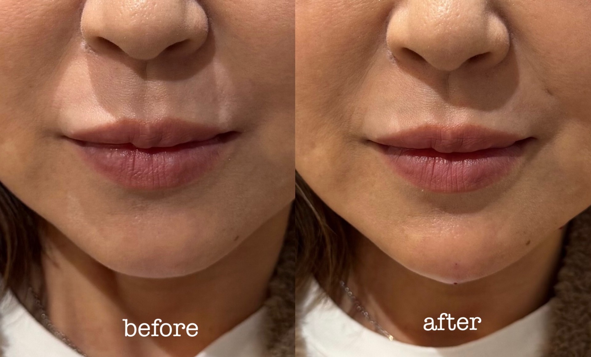 顎のヒアルロン酸注射